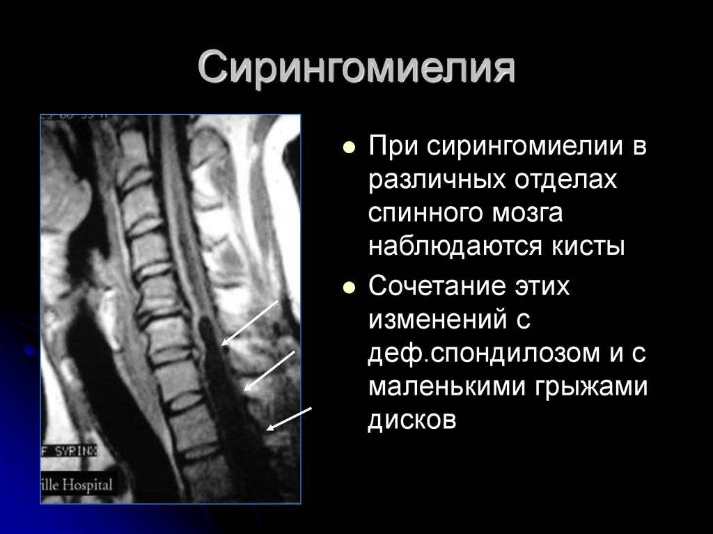 Синдром конского хвоста — диагностика и лечение в израиле