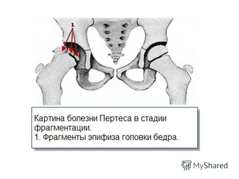 Болезнь пертеса