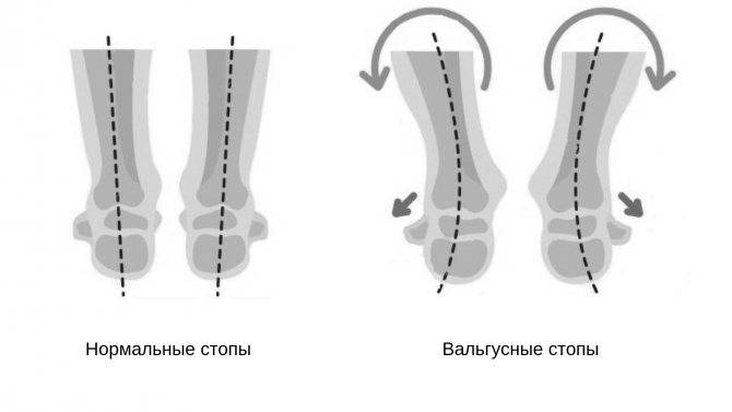 Вальгусная деформация стопы у детей