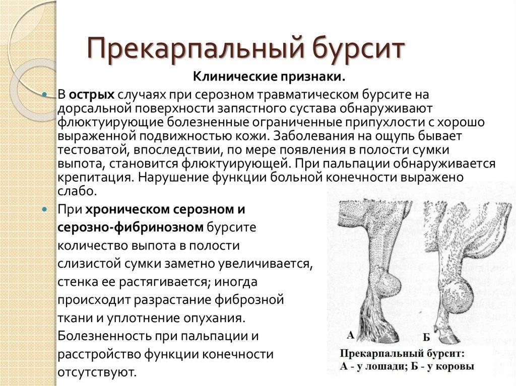 Лечение бурсита плечевого сустава (воспаление синовиальной сумки плеча)
