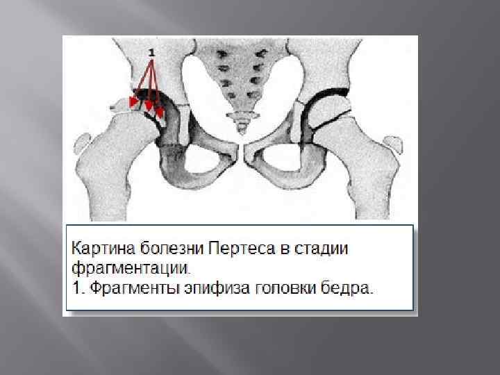 Хирургическое лечение детей с тяжелыми формами болезни пертеса