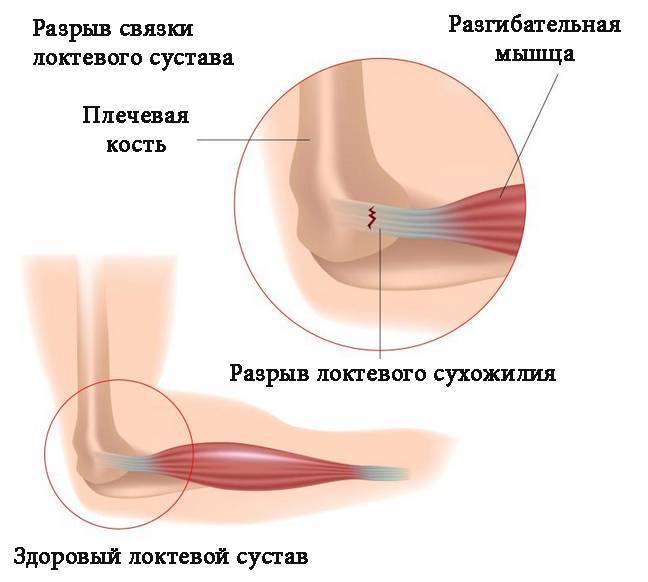 Причины боли в пятке – симптомы, к какому врачу обращаться | боль в пятке при ходьбе и после сна