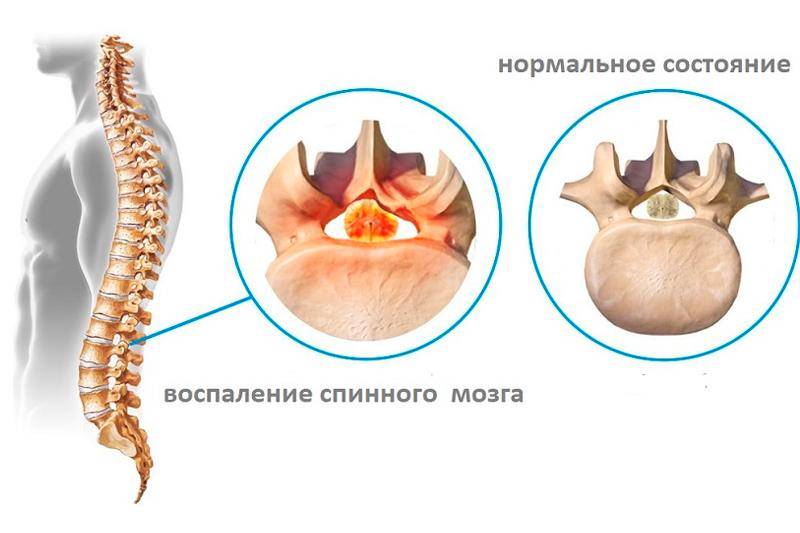 Секвестрированная грыжа диска - лечение, симптомы, причины, диагностика | центр дикуля
