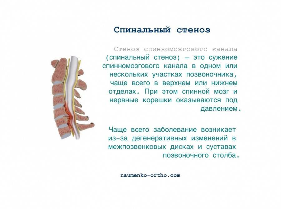 Синдром конского хвоста- что это такое, причины, симптомы, факторы риска, диагностика, лечение