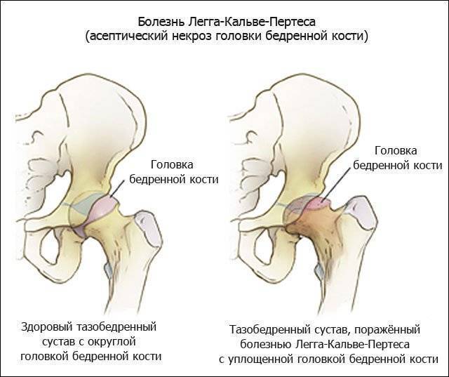 Кандидоз - симптомы, причины развития, лечение