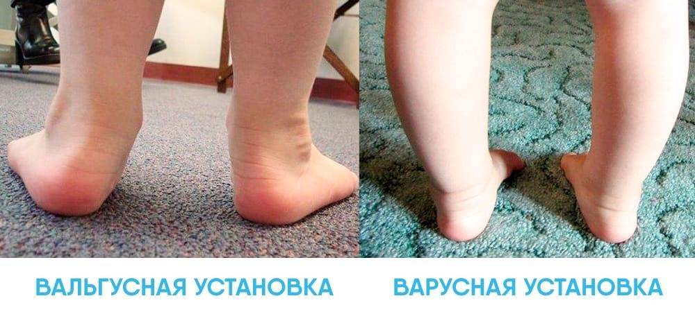Деформация стопы у детей - лечение вальгусной и варусной деформации в клинике санкт-петербурга