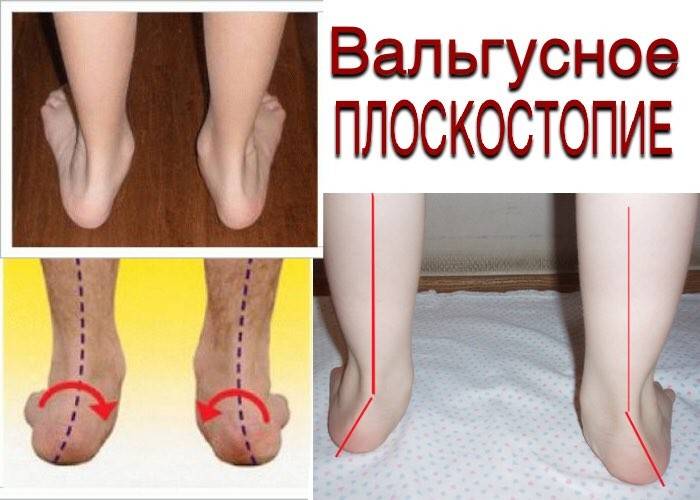 Комплекс упражнений для стоп при вальгусной деформации у ребенка