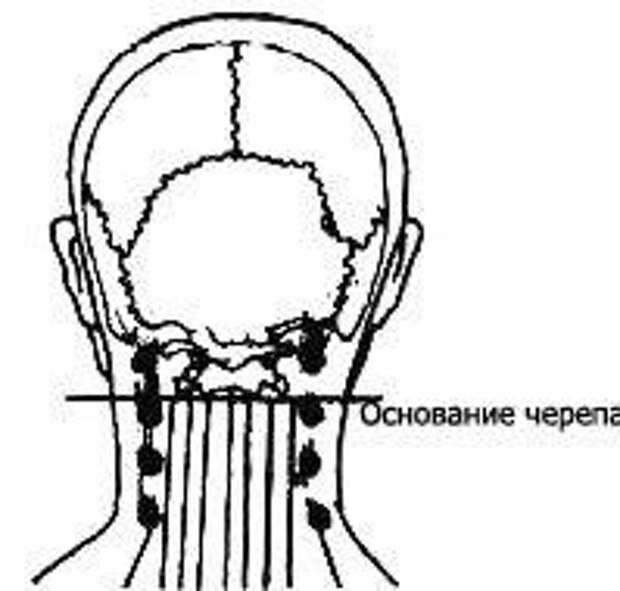 Боли в шее сзади у основания черепа