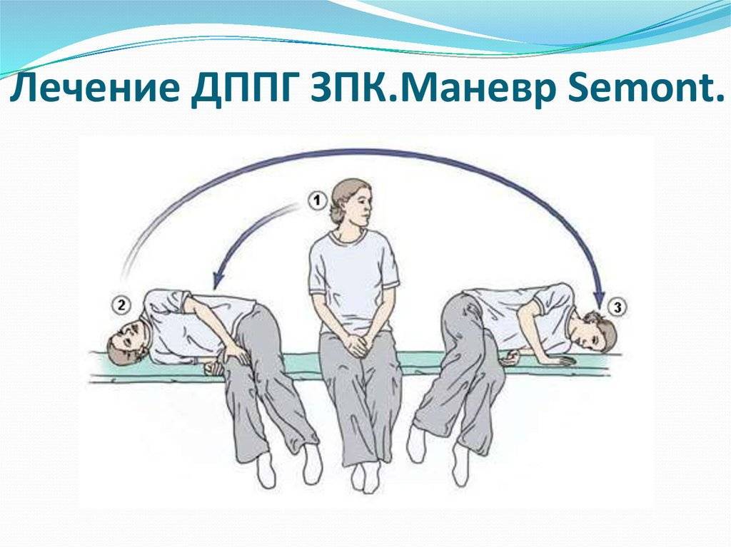Доброкачественное пароксизмальное позиционное головокружение