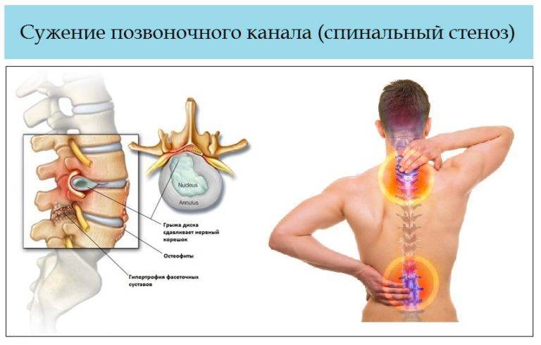 Лечение корешкового синдрома пояснично крестцового отдела позвоночника в москве в клинике дикуля: цены, запись на прием | центр дикуля