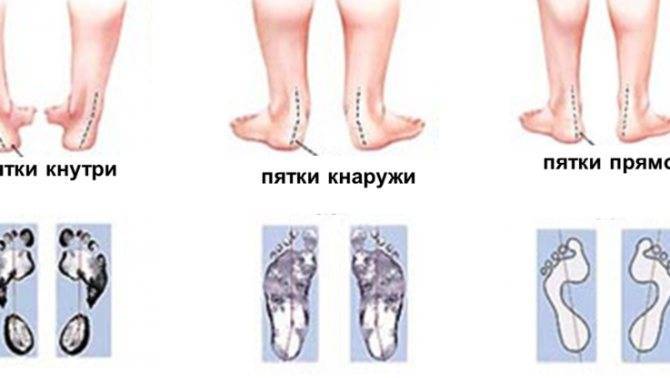 Остеопат при вальгусе у детей