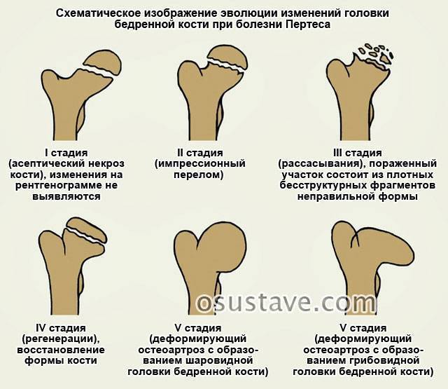"неуклюжий ребенок" или синдром диспраксии у детей