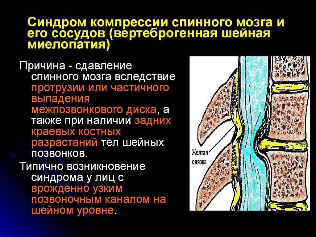 Опухоли позвоночника и спинного мозга