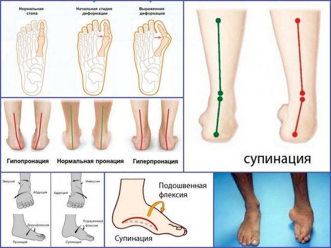 Выпрямление ног - исправление о-образной кривизны (варусной деформации) в москве